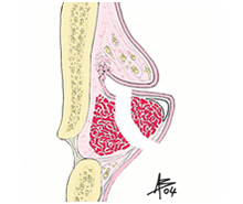 Cordectomia III