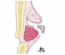 Cordectomia II