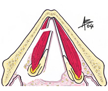 Cordectomia IV