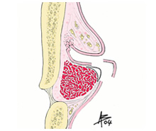 Cordectomia I