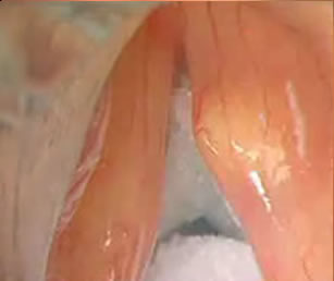 Submucosal cyst laser