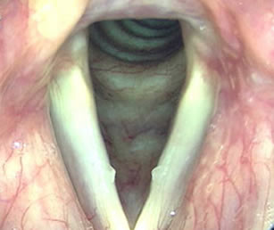 Kissing nodules