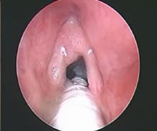 Papillomatosi laringe