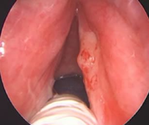 Carcinoma squamocellulare corda vocale destra