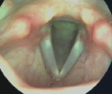 Laryngostroboscopy normal video