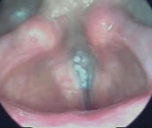 Laryngostroboscopy cancerus video