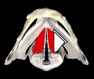 Scollamento muco ligamentoso incompleto