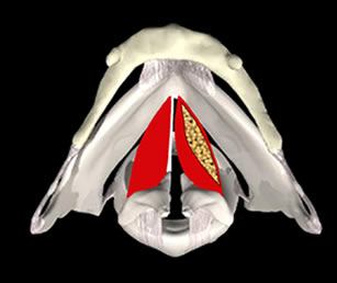 Scollamento muco ligamentoso completo